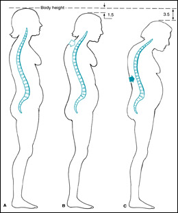 stress affects posture